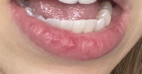 Lip bumps/ rash : r/DermatologyQuestions