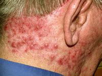 Cure Folliculitis: Folliculitis Symptoms