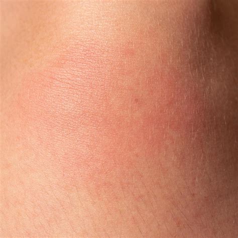 allergie sur le corps humain  rougeur dune piqure de guepe