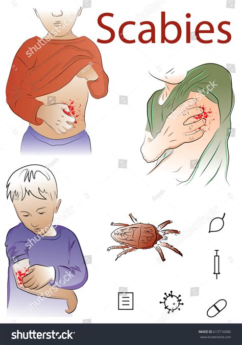 Scabies Vector Illustration Labeled Educational Skin Stock, 41% OFF