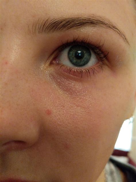 Lines Under Eyes At 12 at Amelia Woodhouse blog