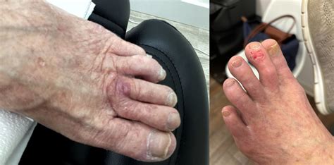 How Does Skin Cancer on the Toes Look? | GentleCure
