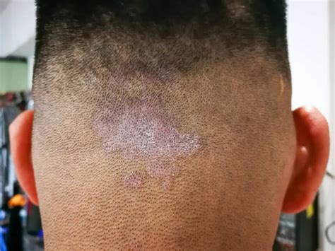 Tinea capitis, una infección del cuero cabelludo en ascenso en España ...