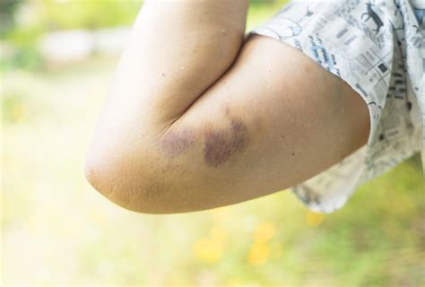 Possible Reasons and Risk Factors for Bruises - eMediHealth
