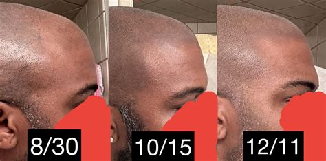 MY FOREHEAD IS SHRINKING 🙏🏿 - 3.5 Month Update : r/tressless