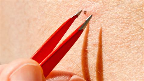 Bad Ingrown Hair Cyst - Surveys Hyatt