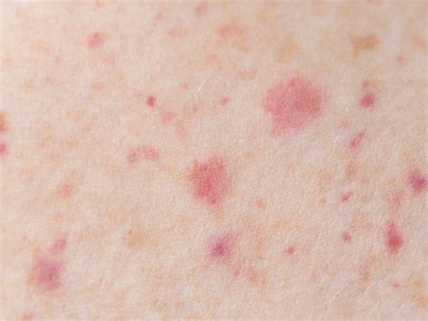 warning signs     skin  turning