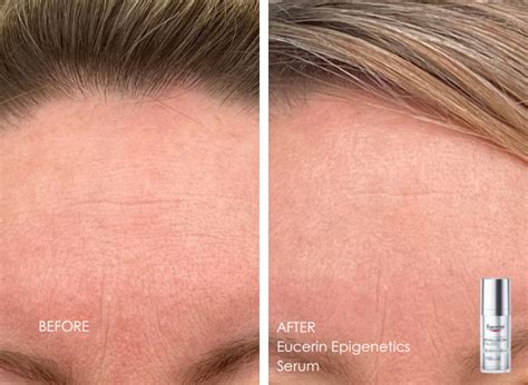 Eucerin Epigenetic Antes E Depois