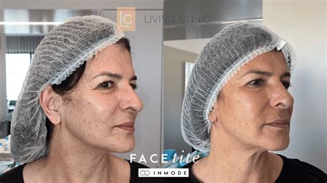 Facetite / Accutite Before and After