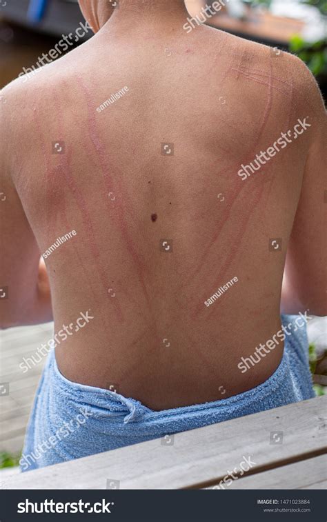 Dermatographic Urticaria Known Dermographism Dermatographism Skin Stock ...