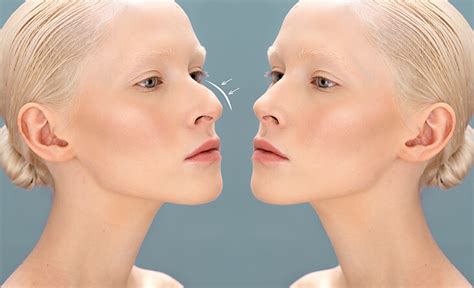 nose surgery cost