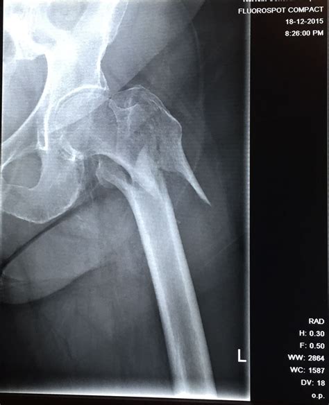 Left Hip Fracture - X-Ray — Steemit