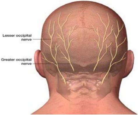 occipital nerve blocks miracle therapy  glorified placebo migraineur