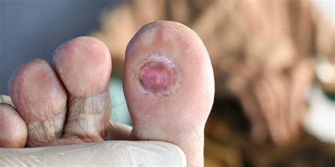 Guide to Treating Foot Ulcers in Diabetes: Effective Solutions and Best ...
