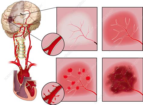 progression  embolic stroke illustration stock image