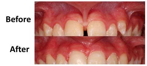 Frenectomy - Smiles On Bristol Dentistry