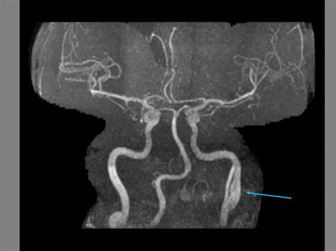 The Pump and the Tubes: Carotid Dissection on MRA