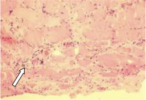 Representative muscle biopsy micrograph (from another patient) shows ...