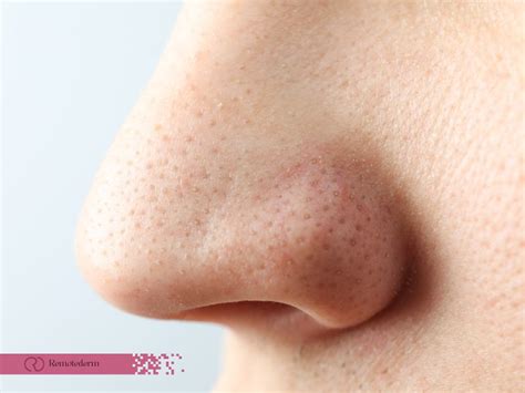 Comedonal Acne, What, Causes and treatmeent - RemoteDerm