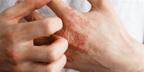 Atopic Dermatitis Treatments | SLO, CA | Coastal Dermatology