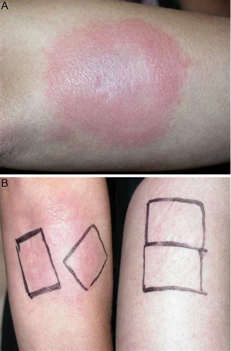Progesterone Autoimmune Dermatitis Responding to Ulipristal Acetate