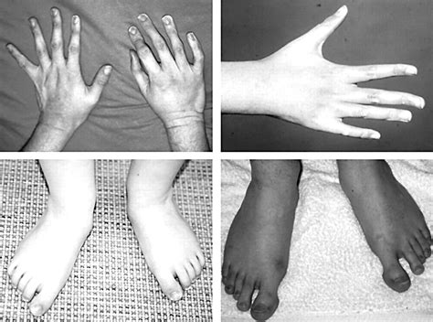 Diagnostic criteria, clinical characteristics, and natural history of ...