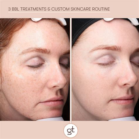 Before & After Gallery of BBL Hero Photorejuvenation Results