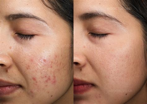 Effective Acne Treatment Options at Qazi Cosmetic Center