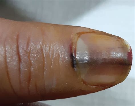 facts  myersons sign factsnet