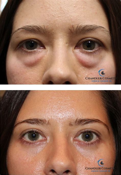 Cosmetic Surgery Eye Bags Uk | IUCN Water