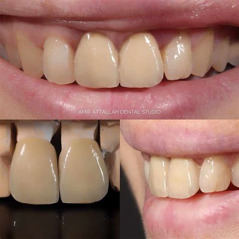Dental Crowns: The Science Behind Protecting and Enhancing Your Teeth