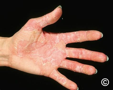 Finger Skin Peeling