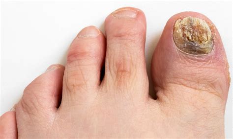 identify fungal nail infections elmens