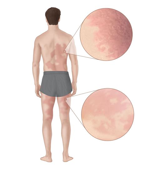 Emerging Tick Bite-Associated Meat Allergy Potentially Affects Thousands
