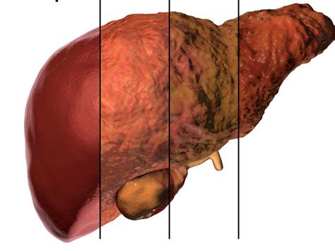 Non-Alcoholic Fatty Liver Disease - Causes, Symptoms, Treatment