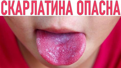 Скарлатина у детей - симптомы и лечение (с фото)