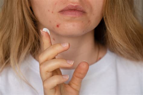 Clascoterone Cream 1% Deemed Stable When Combined With Other Topical