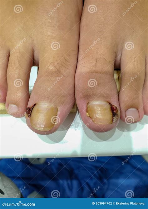 how to fix an ingrown toenail big toe
