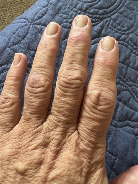 How can I stop the progression of my arthritis in my fingers : r/Thritis