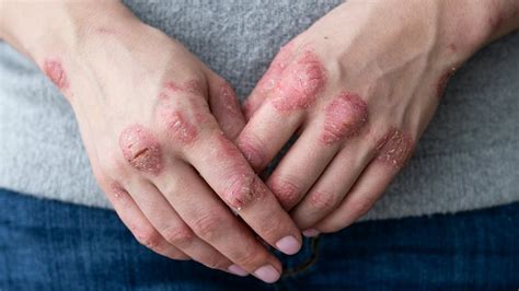 Rhumatisme psoriasique
