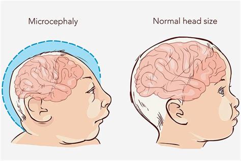microcephaly  babies  symptoms  treatment parenting boss