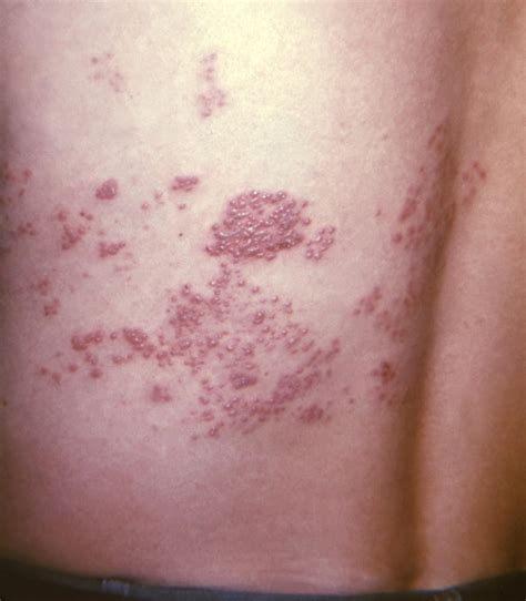 Shingles may pose a 20% higher risk for long-term confusion, memory