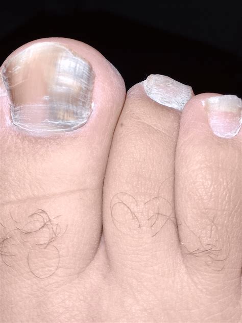 fungus rnailfungus