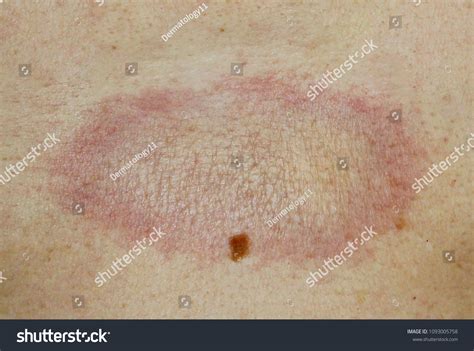 18 Morphea Images, Stock Photos, and Vectors | Shutterstock