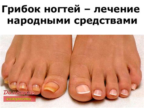 Грибок ногтей – лечение народными средствами