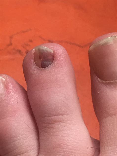 I noticed a small bruise under my toenail a few months ago. It’s