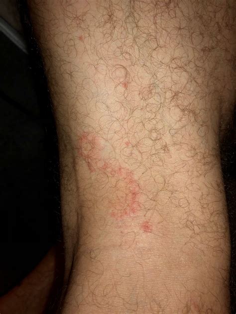 Sudden appearance arms, legs chest, could this be excema? : r/eczema