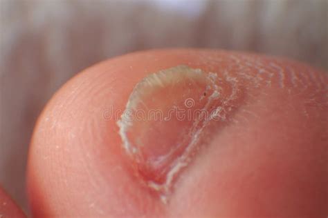 Undeveloped Little Toe Nail on Adult Male Feet Stock Photo - Image of ...