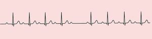 av conduction ecgpedia