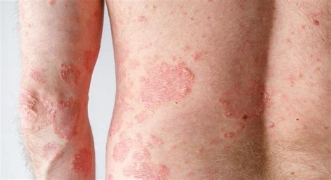 Dr. Sophie Hammerer - Psoriasis (Schuppenflechte) | Hautärztin in 1010